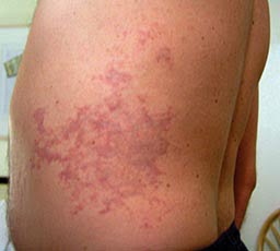 DCS Type 1 skin rash types of decompression sickness