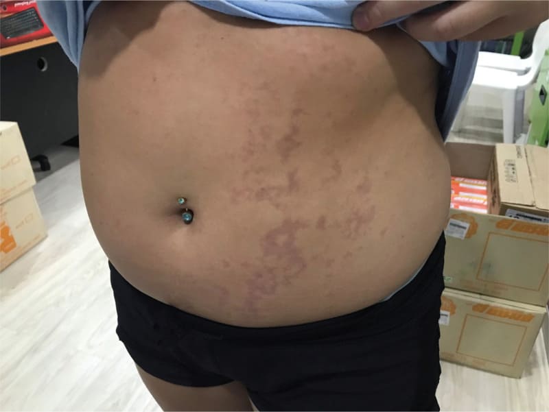 Skin Bends on the stomach